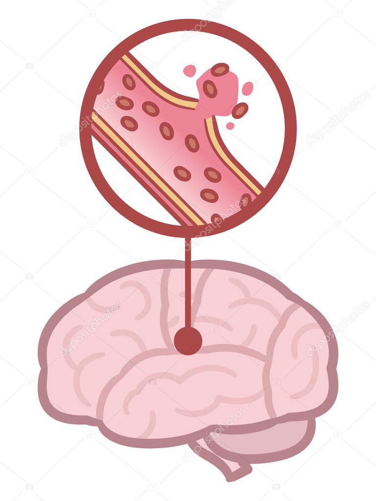 Brain stroke - Illustration of cerebral hemorrhage