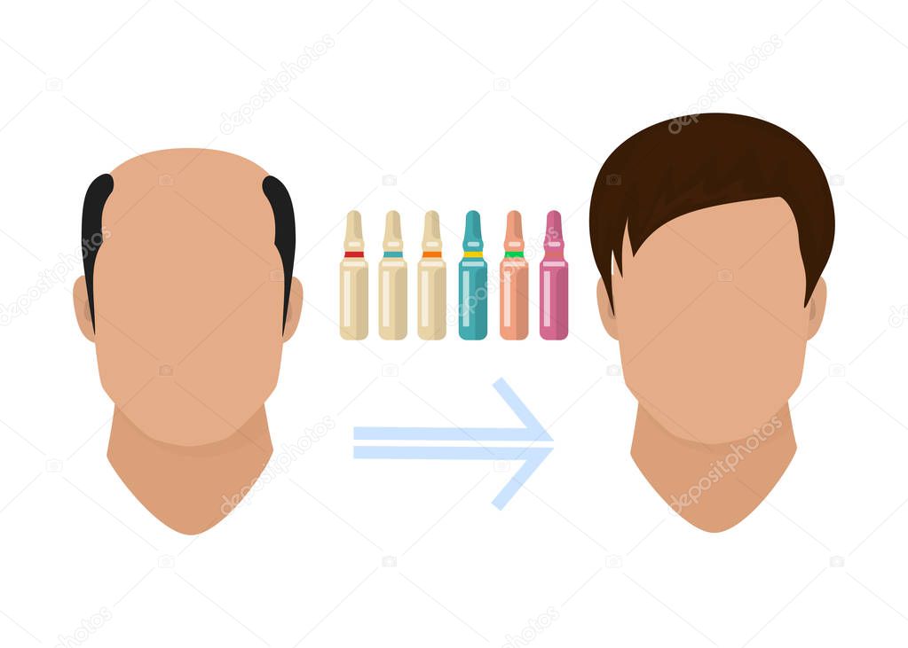 Male hair loss treatment. Before and after stages of hair growth procedure on face silhouette. Alopecia infographic medical template for transplantation clinics and diagnostic centers.