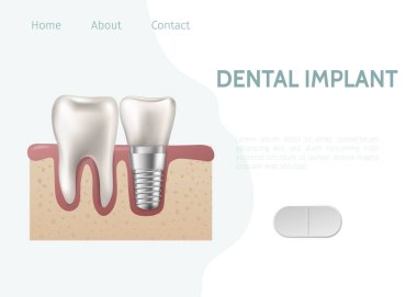 Implant and healthy tooth and structure vector illustration. Dental implant structure with all parts crown, abutment, screw for dental clinic website. clipart