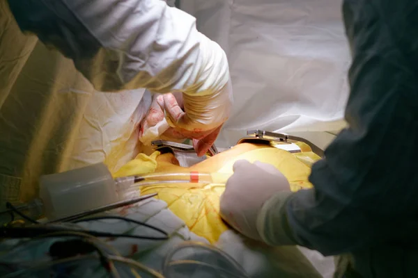 Cirujanos Que Operan Durante Operación Cardíaca Cabg — Foto de Stock