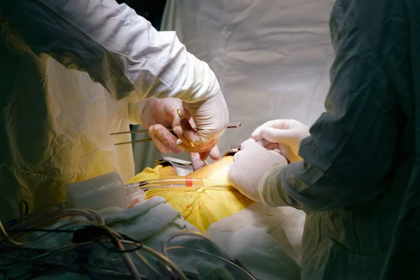 Cirujanos Que Operan Durante Operación Cardíaca Cabg — Foto de Stock