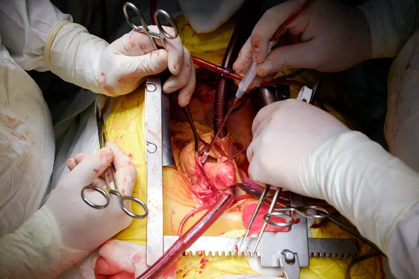 Cirujanos Que Operan Durante Operación Cardíaca Cabg Cerca — Foto de Stock