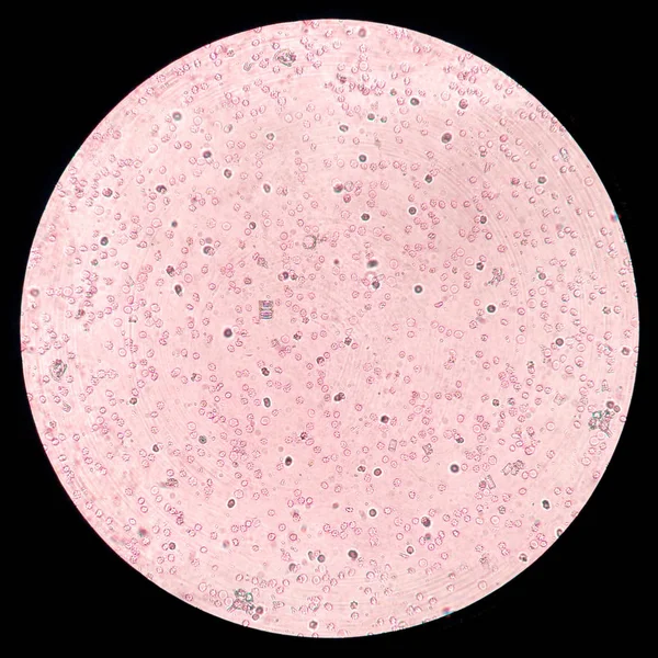 Mikroskop Aufnahme Von Blut Während Des Cross Match Tests — Stockfoto