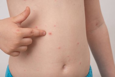 Su çiçeği döküntüsü olan bebek. Varisella virüsü veya suçiçeği kabarcık döküntü çocuk. Dermatoloji kavramı. Toddler vücudunda lekeler gösterir
