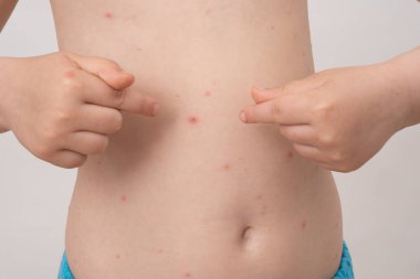 Su çiçeği döküntüsü olan bebek. Varisella virüsü veya suçiçeği kabarcık döküntü çocuk. Dermatoloji kavramı. Toddler vücudunda lekeler gösterir