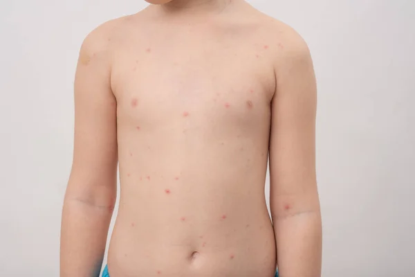 La varicela, también conocida como varicela, es una enfermedad altamente contagiosa causada por la infección inicial con el virus varicela zóster. — Foto de Stock