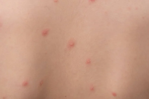 Erupción de la varicela en el cuerpo de un niño pequeño.La varicela es una infección causada por el virus de la varicela zóster. Comienza como una erupción similar a una ampolla que se origina en la cara — Foto de Stock