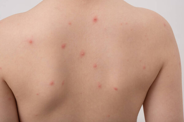 Closeup of back of boy with Varicella virus or Chickenpox. Bubble rash on child.