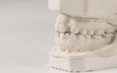 Diş döküm alçıtaşı insan çenesi modeli. Çarpık dişler ve distal ısırık. Atışlar tedaviden önce diş telleriyle yapılmış. Gri arkaplanda teknik çekimler.