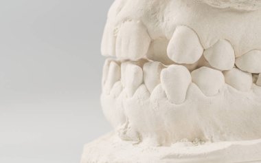 Diş döküm alçıtaşı insan çenesi modeli. Çarpık dişler ve distal ısırık. Atışlar tedaviden önce diş telleriyle yapılmış. Gri arkaplanda teknik çekimler.