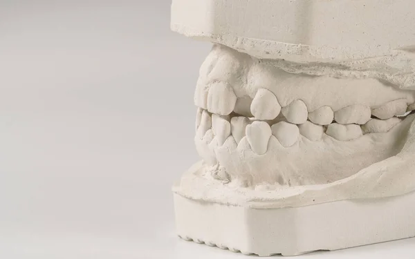 Dental Casting Gypsum Model Human Jaws Crooked Teeth Distal Bite — Stock Photo, Image