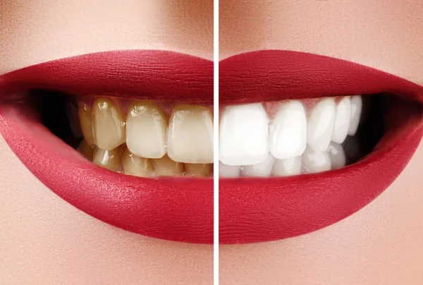 Closeup makró női fogak előtt és után Whitening. Fogászati egészségügyi és szájápolási koncepció. Boldog mosoly a Red Lips — Stock Fotó