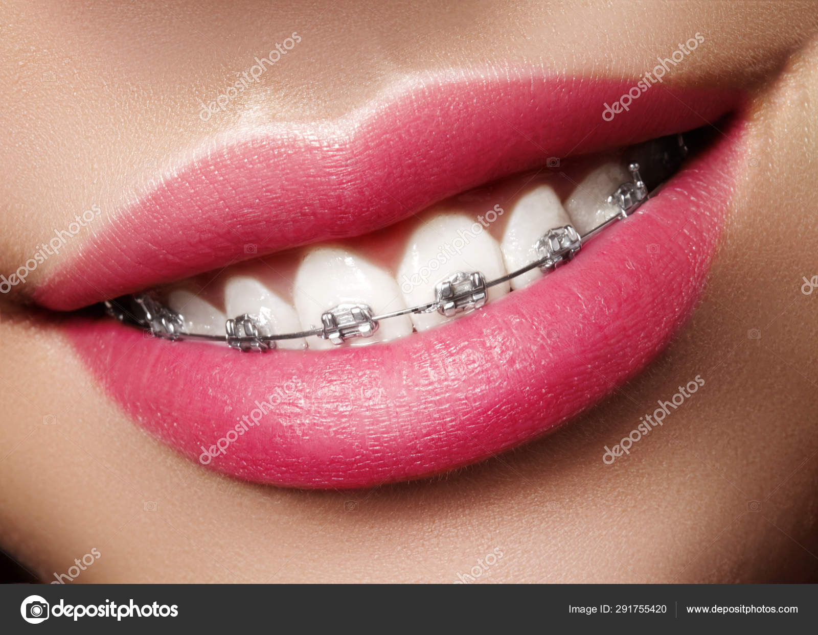 Glossy Lips With Braces