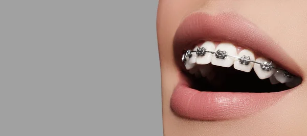 Piękne białe zęby z szelkami. Opieka stomatologiczna zdjęcie. Kobieta uśmiech z akcesoriami ortodontic. Ortodoncja leczenie — Zdjęcie stockowe
