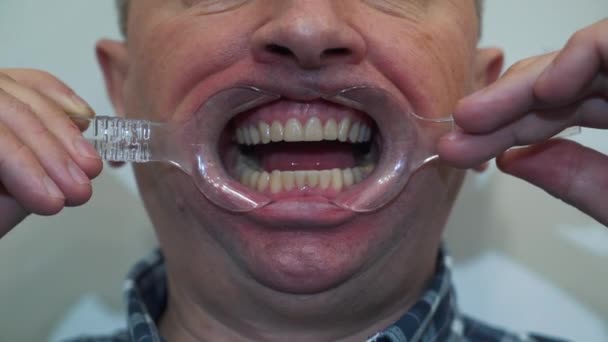 Стоматолог использует расширитель полости рта — стоковое видео