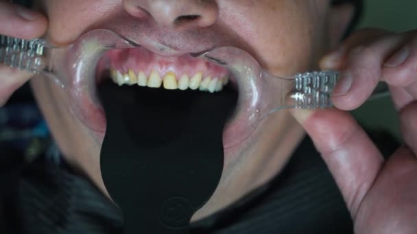 Pacientes dientes primer plano bajo la operación — Vídeo de stock