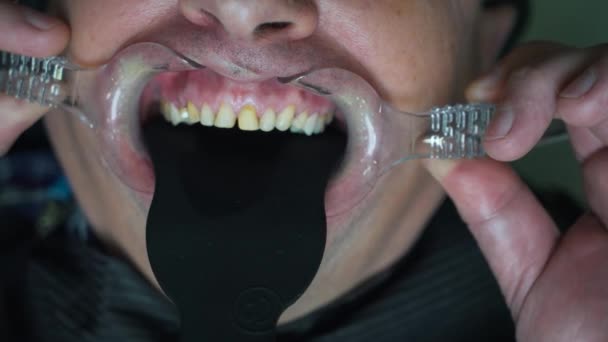 Patienten Zähne aus nächster Nähe unter der Operation