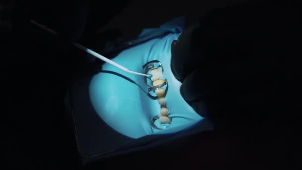 Tandarts installeert veneers aan de patiënt — Stockvideo