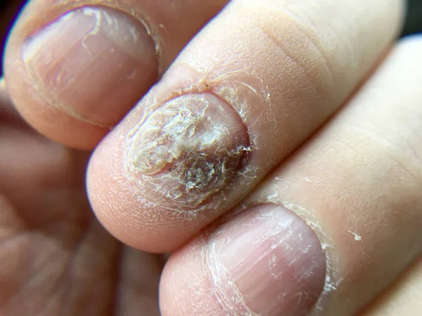 Big Close Fungus Infection Nails Hand Finger Onychomycosis Fungal Infection — Stock Photo, Image