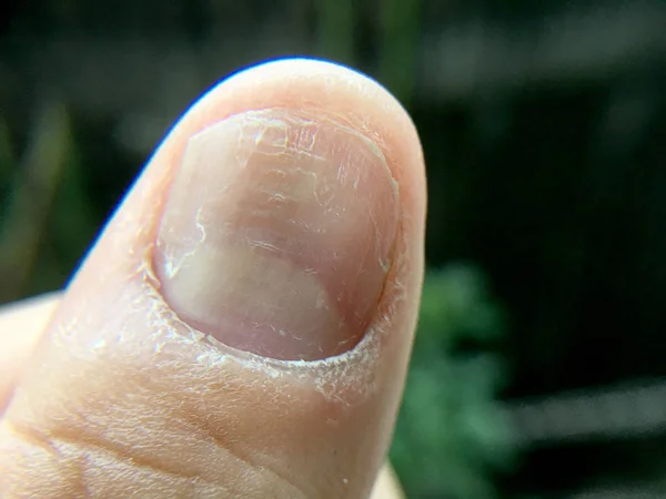 指甲手真菌感染大关闭 手指与甲真菌病 指甲真菌感染 — 图库照片