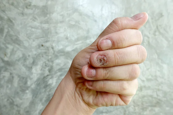 Закриття Грибкової Інфекції Нігтів Грибкова Інфекція Нігтях Рука Палець Оніхомікозом — стокове фото