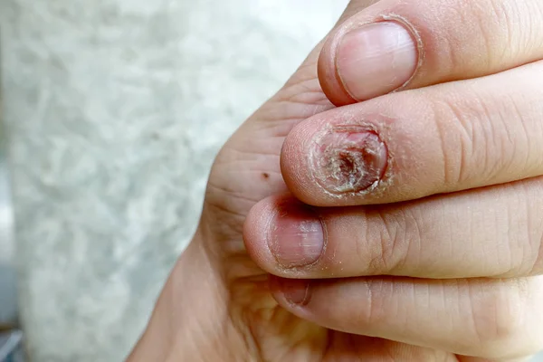 Nærbillede Svamp Søm Infektion Svampeinfektion Negle Hånd Finger Med Onychomycosis - Stock-foto