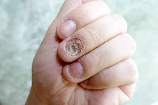 Gomba a kézen és az ujjak között fotó, tünetek, kezelés