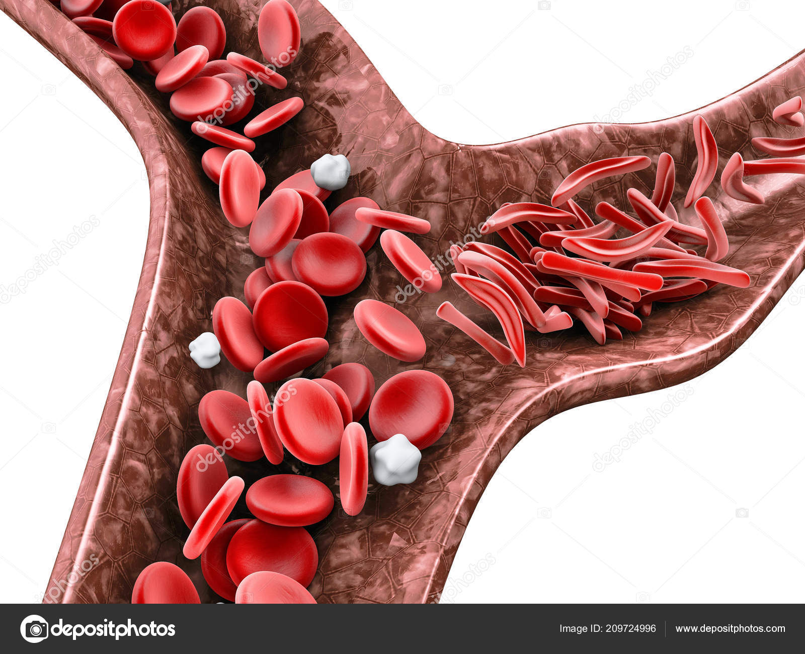 Гемоглобин при язве. Гемоглобин серповидноклеточная анемия. Эритроциты в крови анемия. Серповидноклеточная анемия эритроциты. При серповидно-клеточной анемии гемоглобин:.