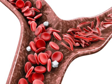 Sickle cell anemia, 3D illustration showing blood vessel with normal and deformed crescent isolated white clipart