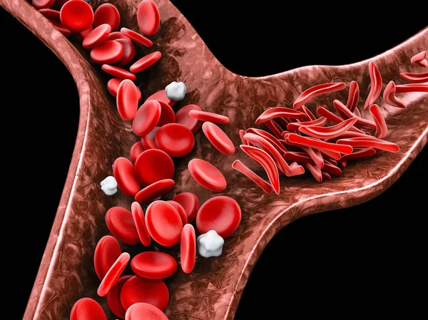 Δρεπανοκυτταρική αναιμία, 3d απεικόνιση δείχνει αιμοφόρο αγγείο με κανονική και παραμορφωμένο ημισέληνος — Φωτογραφία Αρχείου