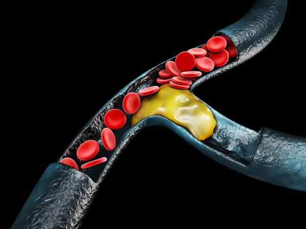 3d Иллюстрация церебрального склероза изолированный черный фон
