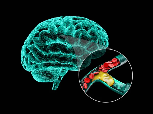 Cerebro humano con esclerosis cerebral. Anatomía cerebral humana Ilustración 3D . — Foto de Stock
