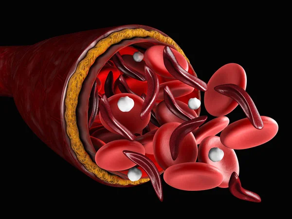 Rozdíl od normálních červených krvinek a srpkovité, 3d obrázek o lékařské — Stock fotografie