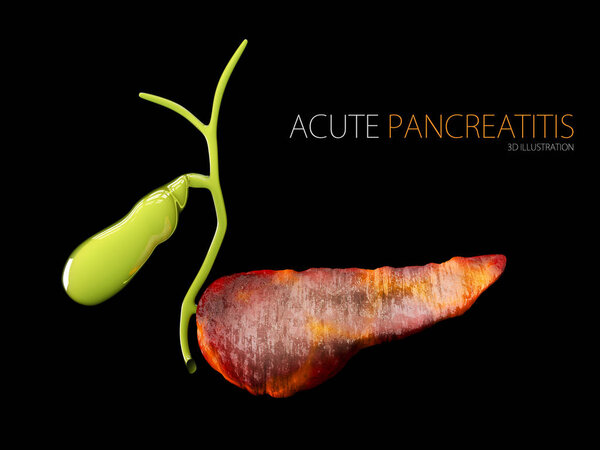 Acute pancreatitis 3d illustration, inflammation of pancreas on a black background