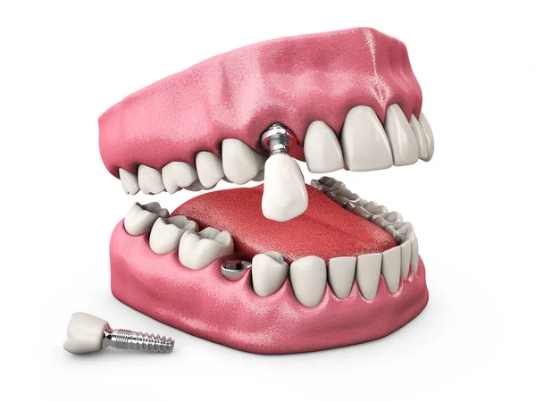 Människans tänder och tandimplantat. 3D illustration. — Stockfoto