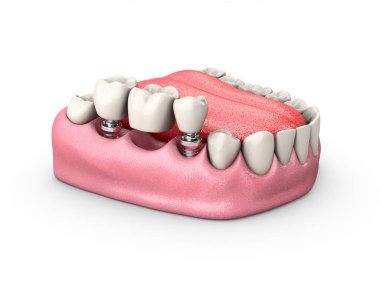 Sabit Kısmi takma diş köprü, 3D illüstrasyon izole beyaz