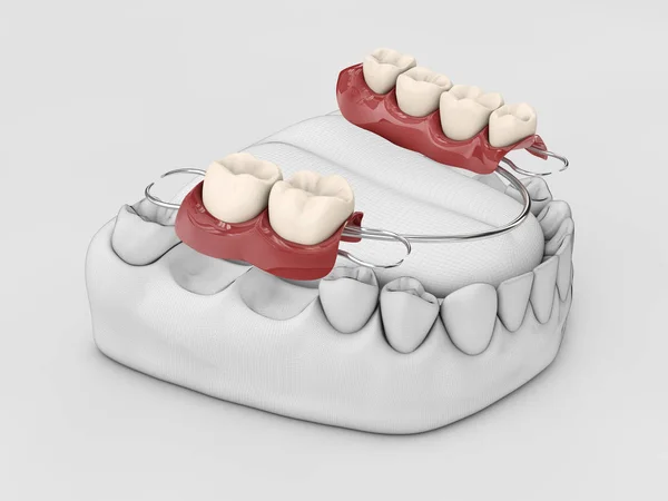 Dientes humanos con prótesis dental. Ilustración 3d aislado blanco — Foto de Stock