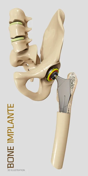 髋关节置换, 人工关节3d 图示 — 图库照片