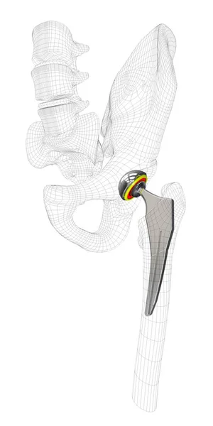 Ilustración Del Reemplazo Articulación Cadera Blanco Aislado —  Fotos de Stock
