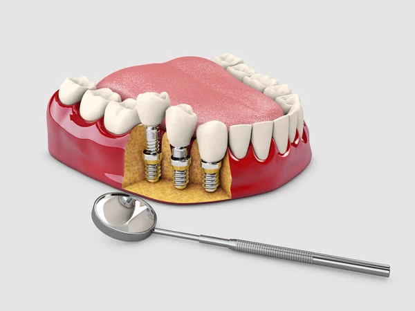 Dientes Humanos Implante Dental Ilustración —  Fotos de Stock