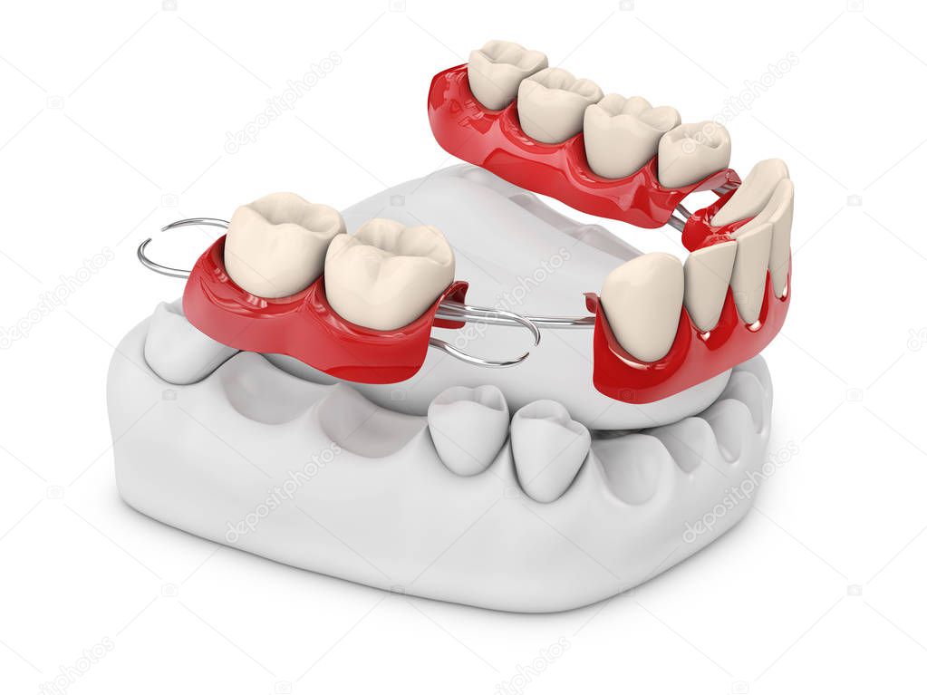 Human teeth with denture. 3d illustration isolated white.
