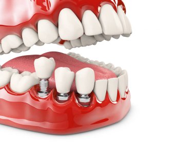 İnsan dişleri ve Dental implant. 3D çizim.