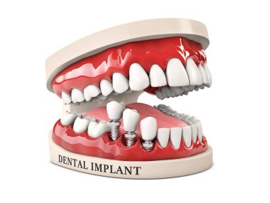 İnsan dişleri ve Dental implant. 3D çizim stok.