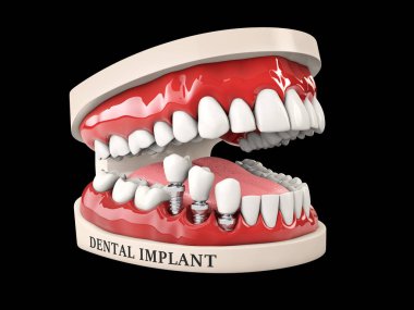 İnsan dişleri ve implant diş izole siyah 3D çizimi.