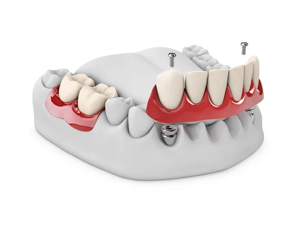 Anatomía Dientes Sanos Implante Dental Hueso Mandíbula Concepto Estomatología Ilustración — Foto de Stock