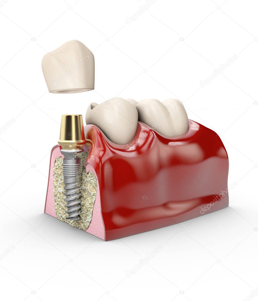 jaw model tooth implant 3d illustration isolated white.