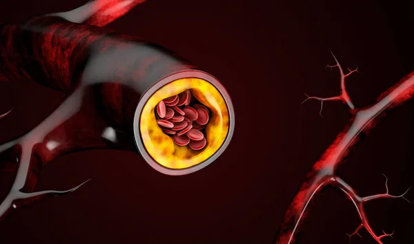 血液细胞与胆固醇斑块堆积的图示 — 图库照片