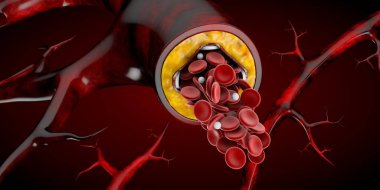 Stent tıbbi implant kavramı bir kalp hastalığı tedavi sembolü 3d örnek olarak.