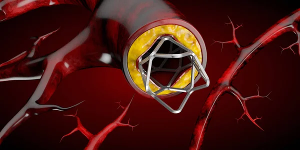 Concept Implant Médical Endoprothèse Comme Symbole Traitement Des Maladies Cardiaques — Photo