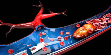 3dillustration serebral skleroz izole siyah arka plan